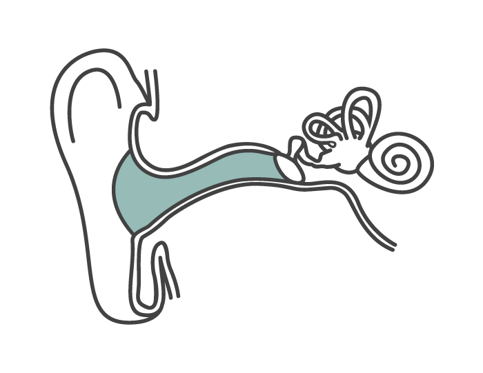 Diagram of an ear highlighting the outer and middle ear where conductive hearing loss occurs