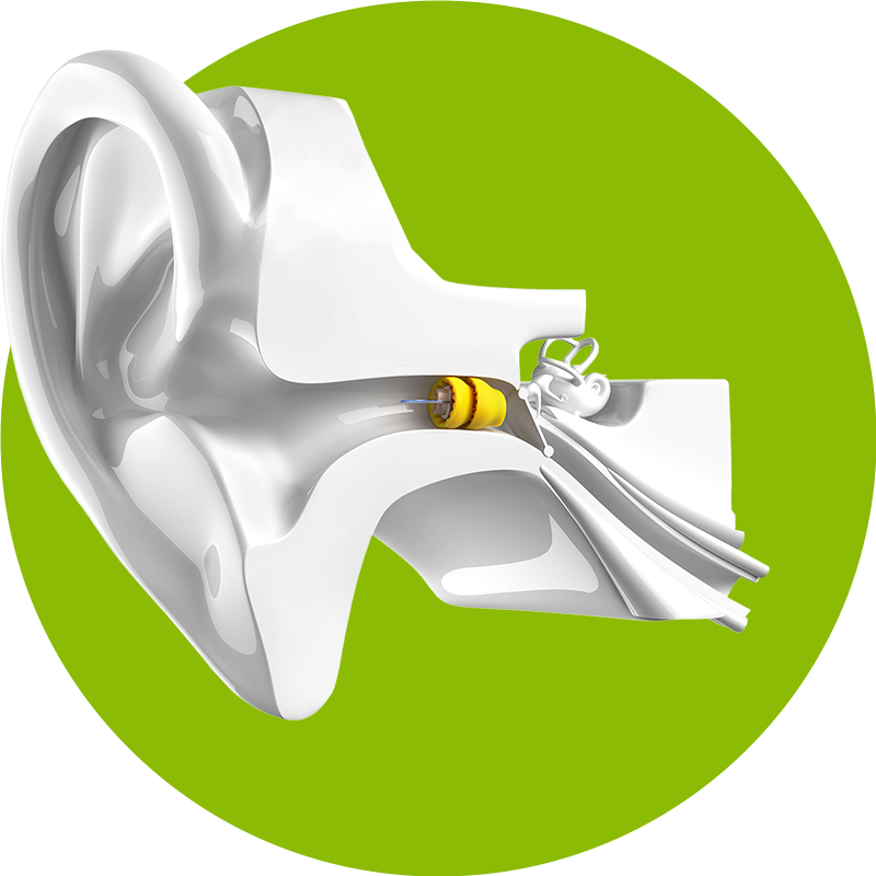 diagram of a Phonak Lyric™ device in the ear canal