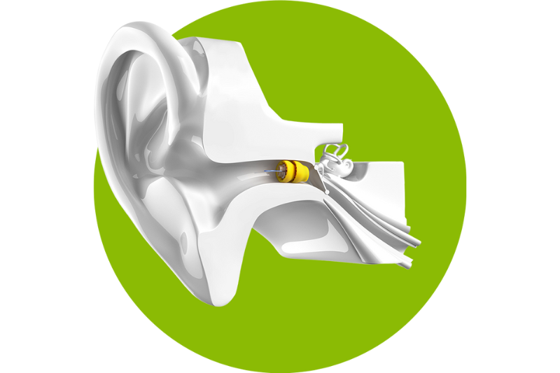 Invisible Lyric hearing aid placed deep within the ear canal