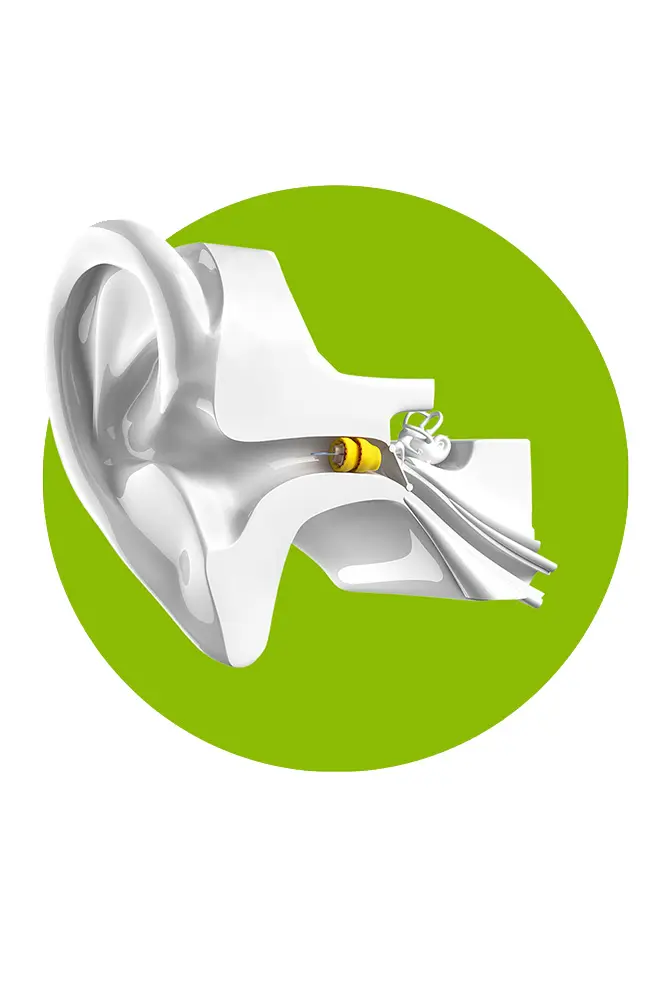 diagram of a Phonak Lyric™ device in the ear canal